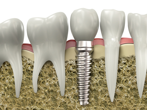 Best Dental Implants in Melbourne Florida Artistic Touch