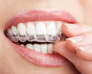 Invisalign And You