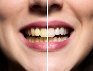 Don’t Let Tooth Discoloration Stop You From Smiling