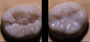Sealants Aren’t Just For Kids