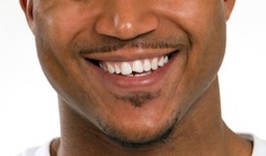 What Is Dental Bonding Good For?
