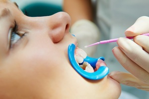 Dental Sealants Protect Hard To Reach Places