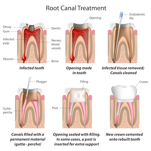 What Is A Root Canal?