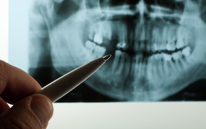 What Is A Root Canal?
