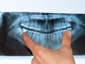 Dental X-Rays Are Safer Than You Think