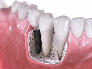 Dental Implants Look, Feel, and Function Like Natural Teeth