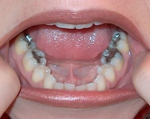 What Are The Disadvantages of Silver Fillings?
