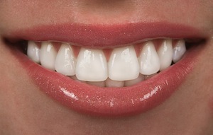 Why Choose Porcelain Veneers?