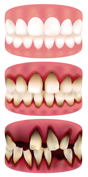 Bleeding gums? Listen up!
