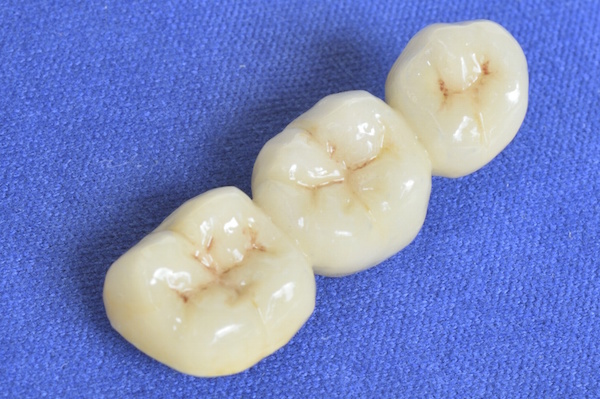 Why choose dental sealants?