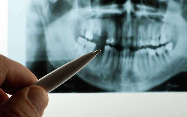 Regenerative Therapy of Periodontal Tissues
