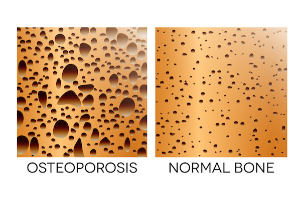 What’s the link between bone loss and gum disease?