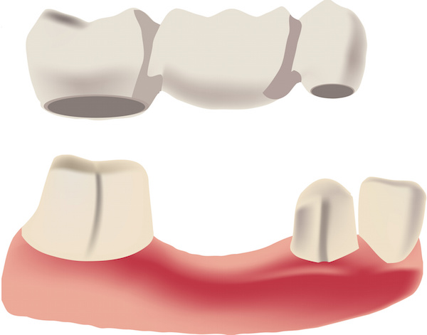 Dental bridge options