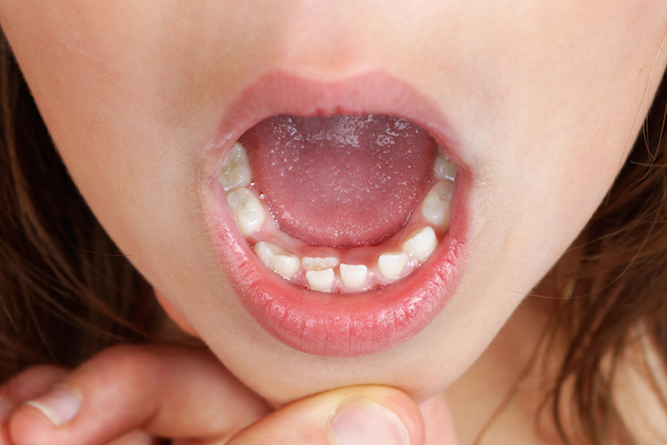 Kid with permanent tooth, bottom incisor, growing and pushing baby tooth out