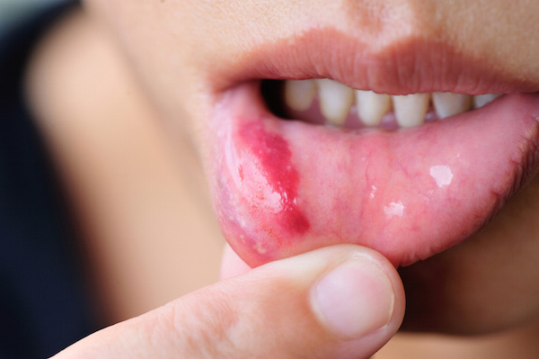Woman show her lower lip of the mouth with injury