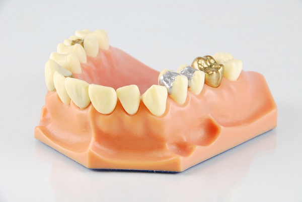 dental model showing different types of treatments (gold crown, porcelain veener, gold inlays, amalgam and composite fillings)