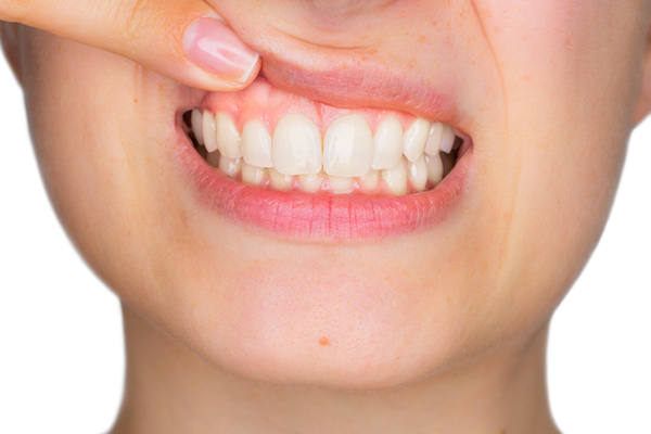 Closeup portrait of young woman showing, with his finger, the upper gingiva with pain expression. Dental care and toothache.