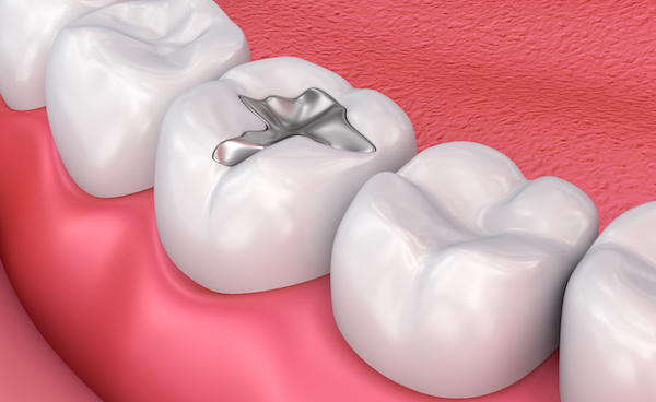 Metall dental fillings, Medically accurate 3D illustration