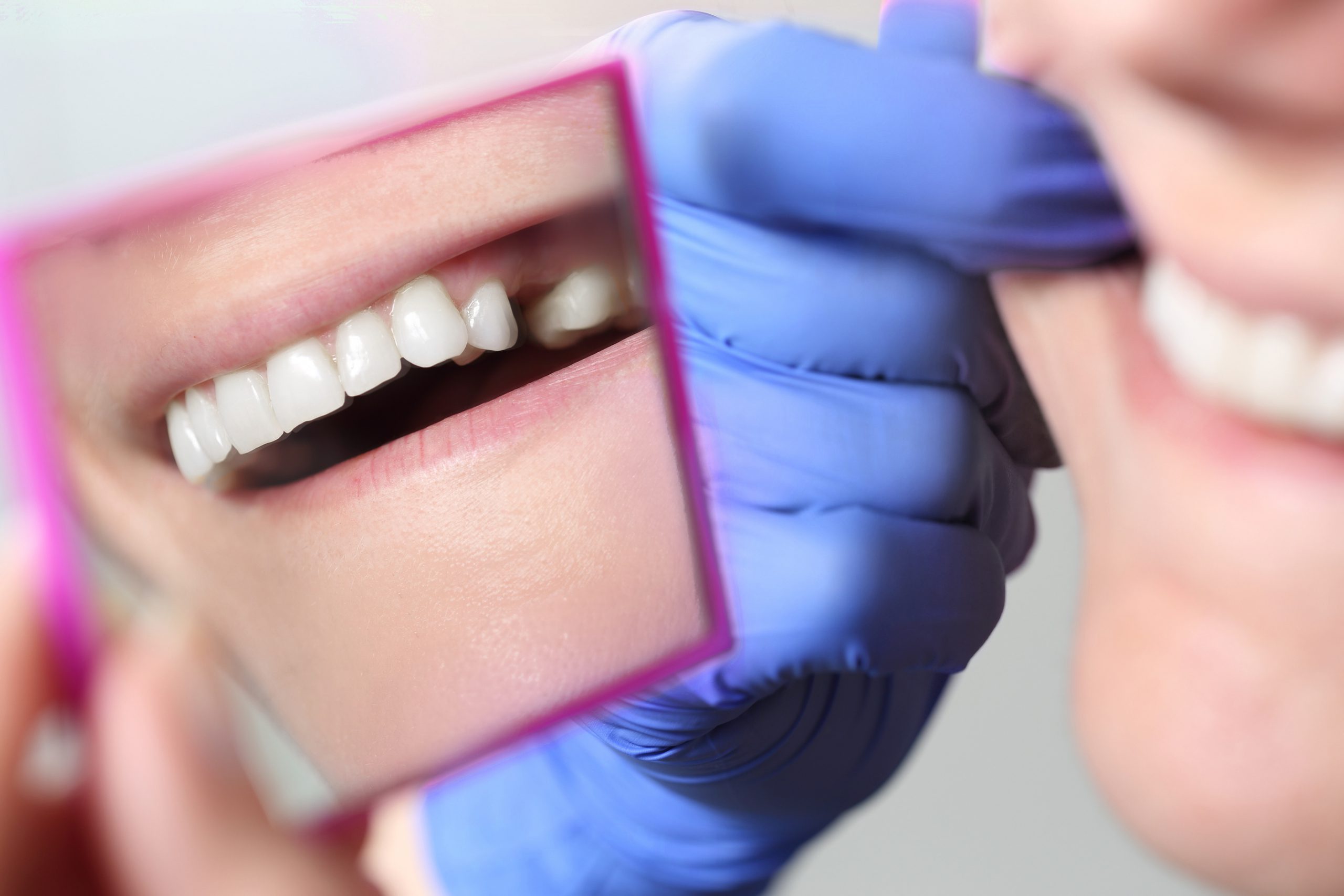 Patient looking in mirror at dentist office in Melbourne Florida considering Dental Bridge.