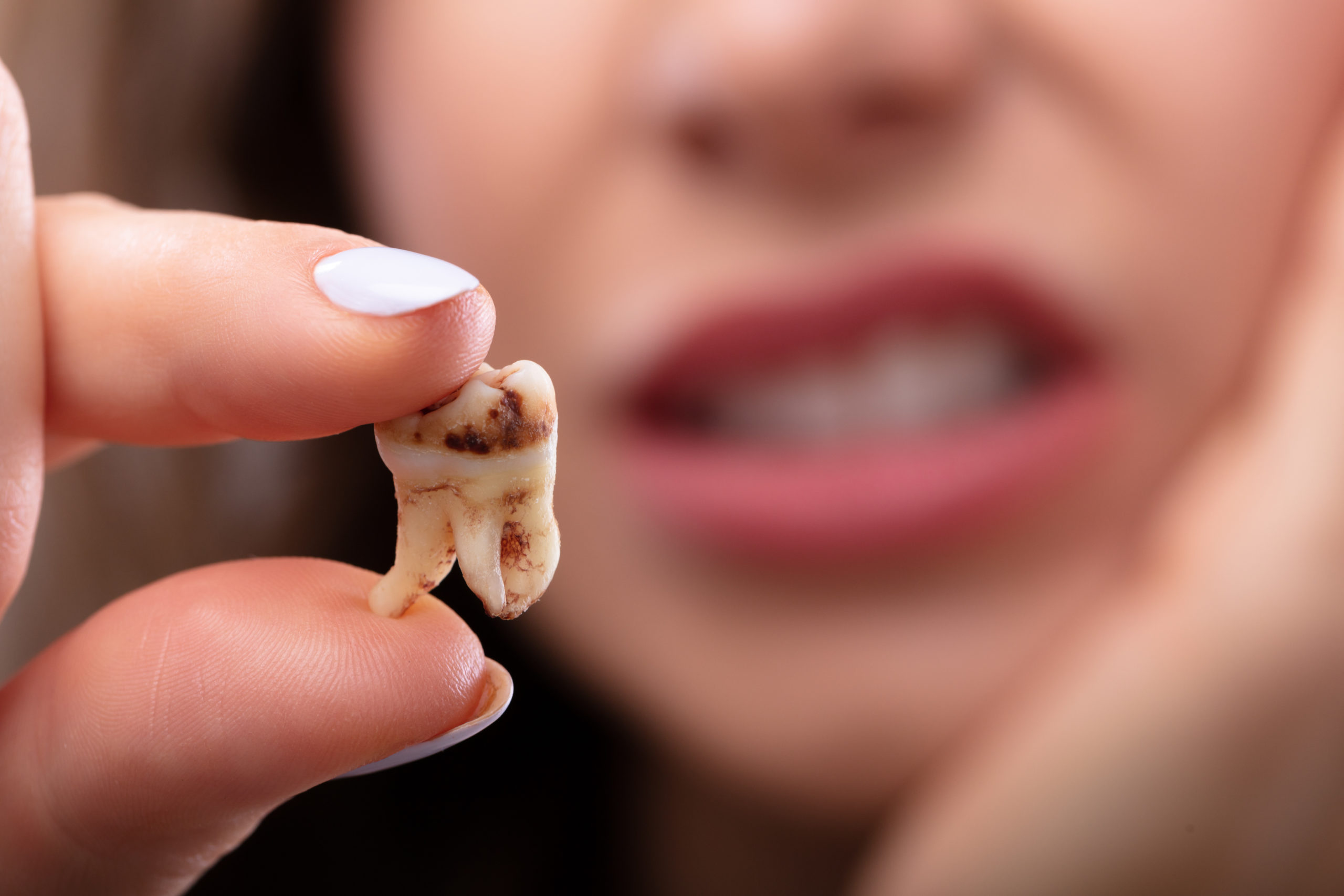 Close-up Of A Woman's Hand Holding Decay Tooth Tooth Decay oral hygiene
