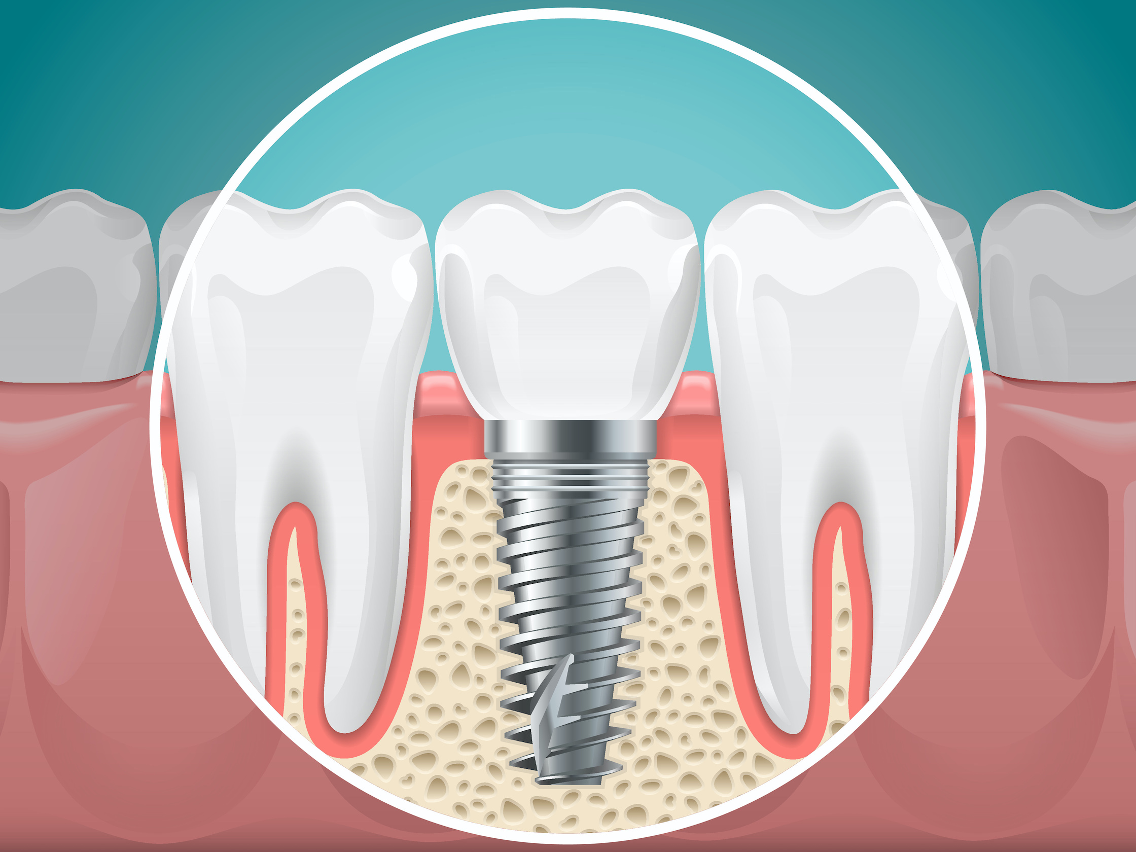 Are Dental Implants Right For You?