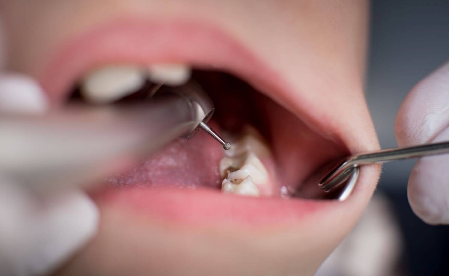 how do Melbourne Florida dentists fix cavities healthy