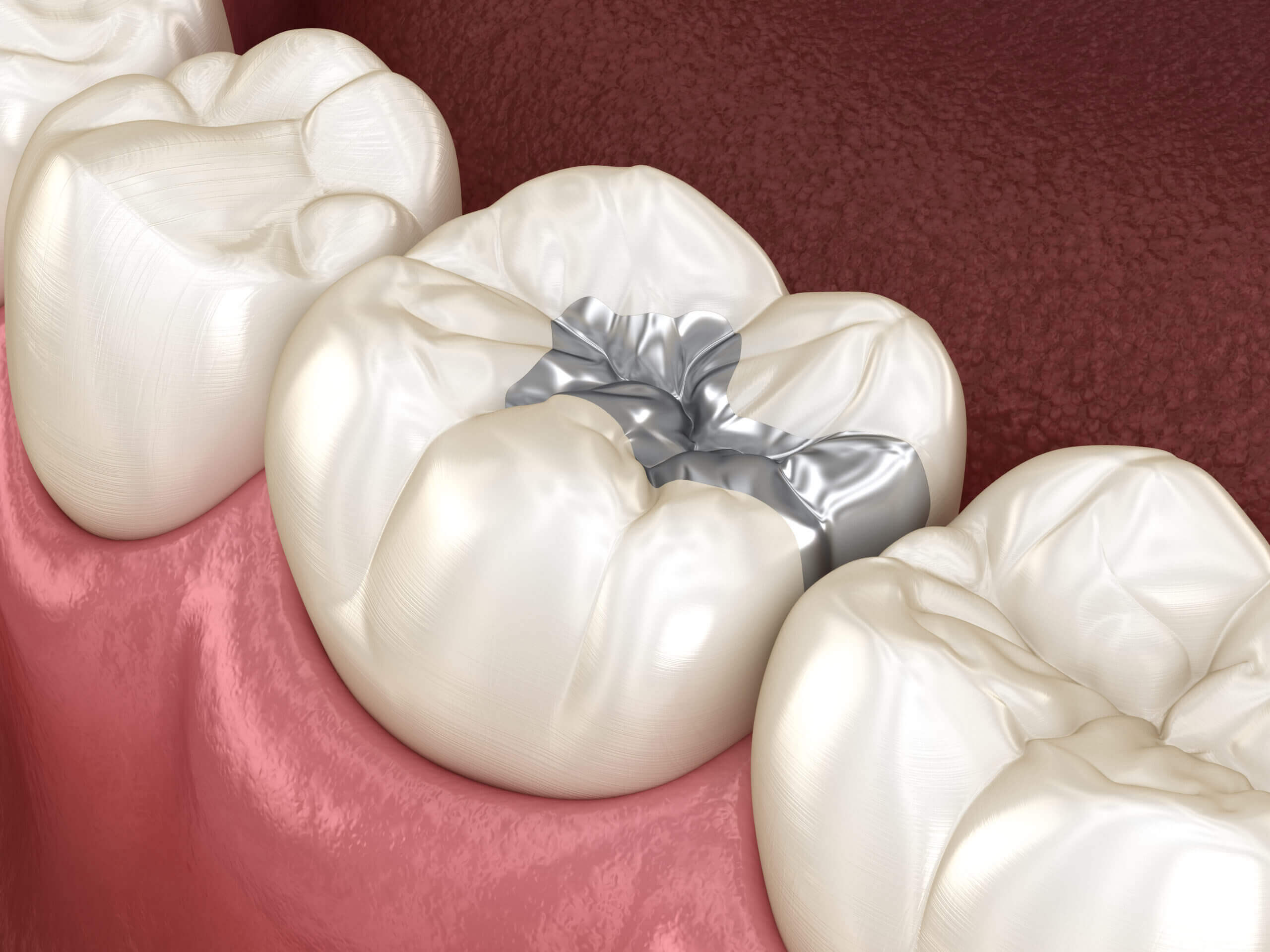 silver fillings Inlay silver crown fixation over tooth. Medically accurate 3D illustration of human teeth treatment