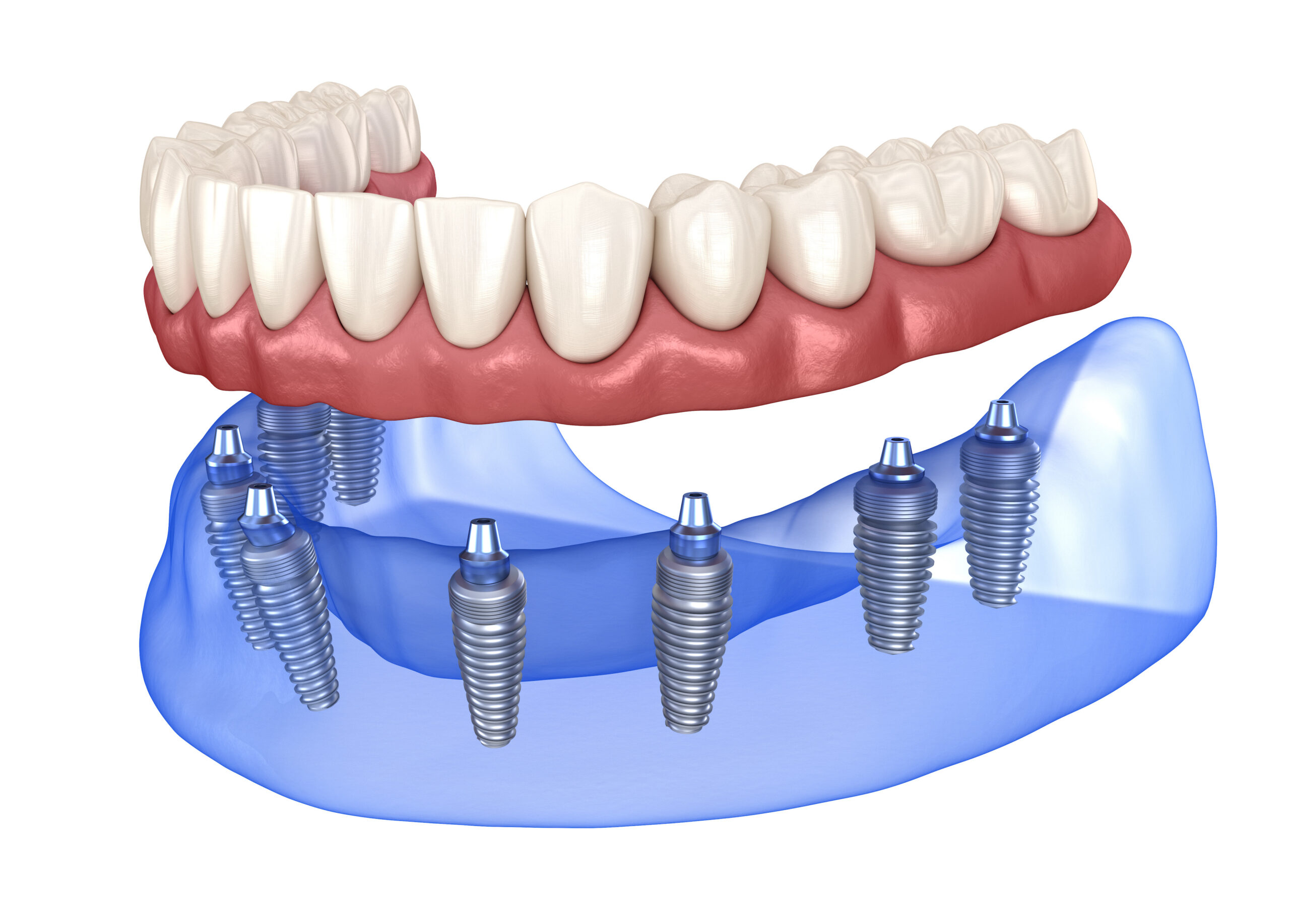 Implants