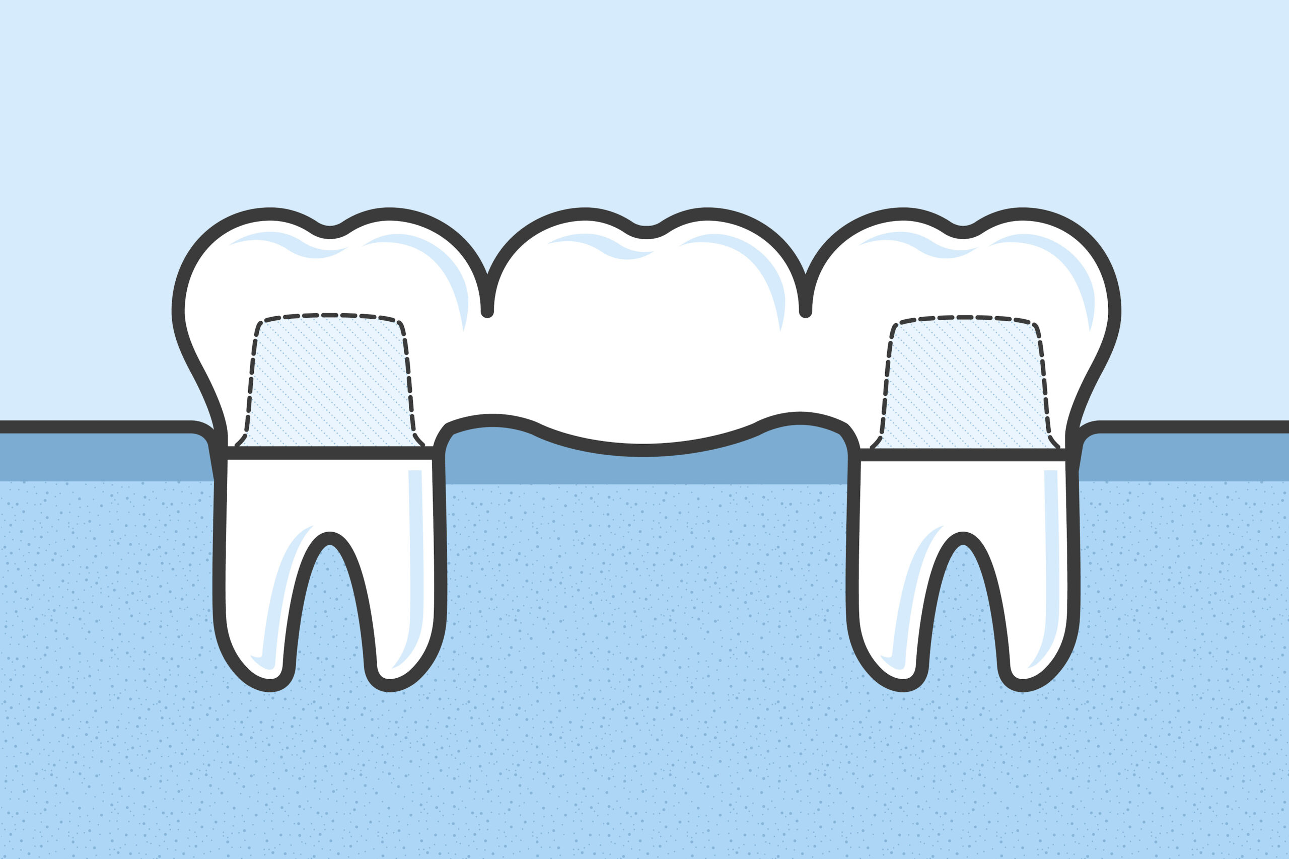 Dental Bridge