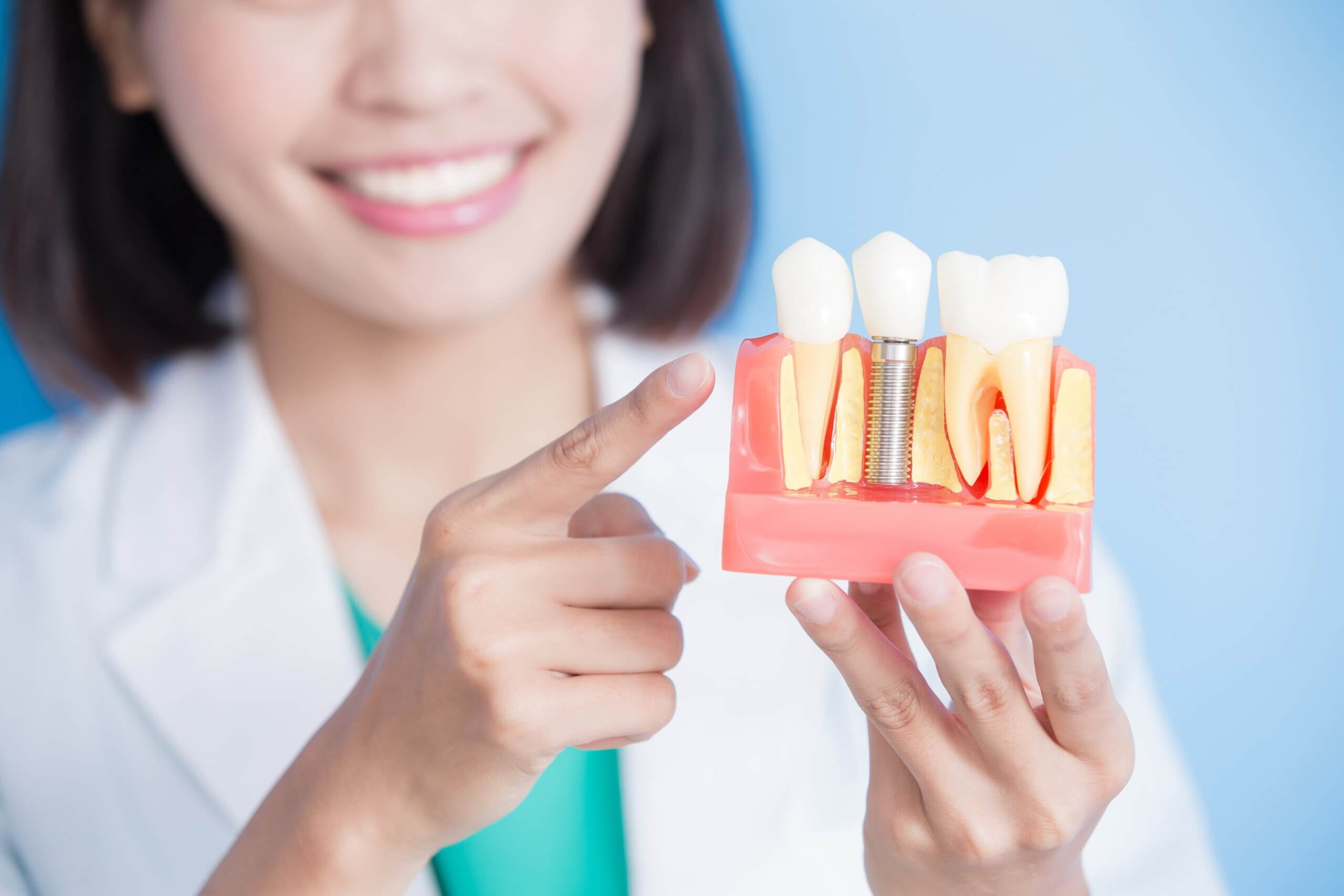 Things You Should Know When Considering Dental Implants