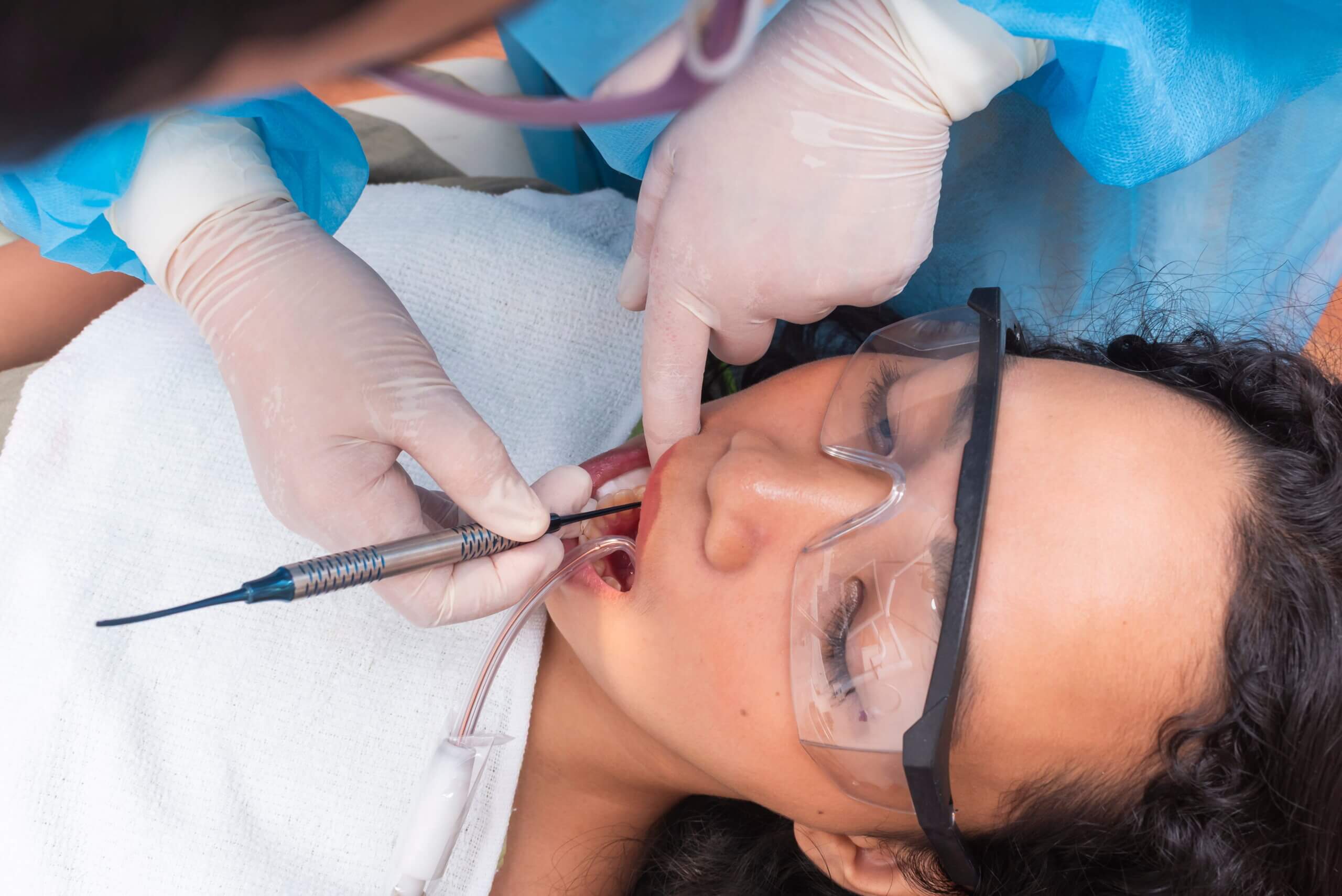 Acid Erosion: The Hidden Cause of Tooth Damage