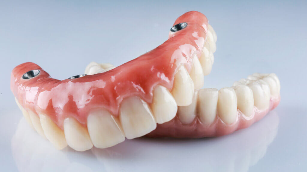 All-on-Four hybrid prosthesis Melbourne FL dentist