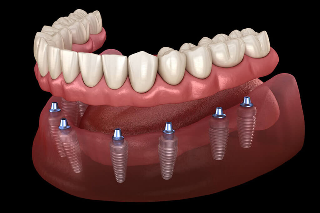 dentures in Melbourne 