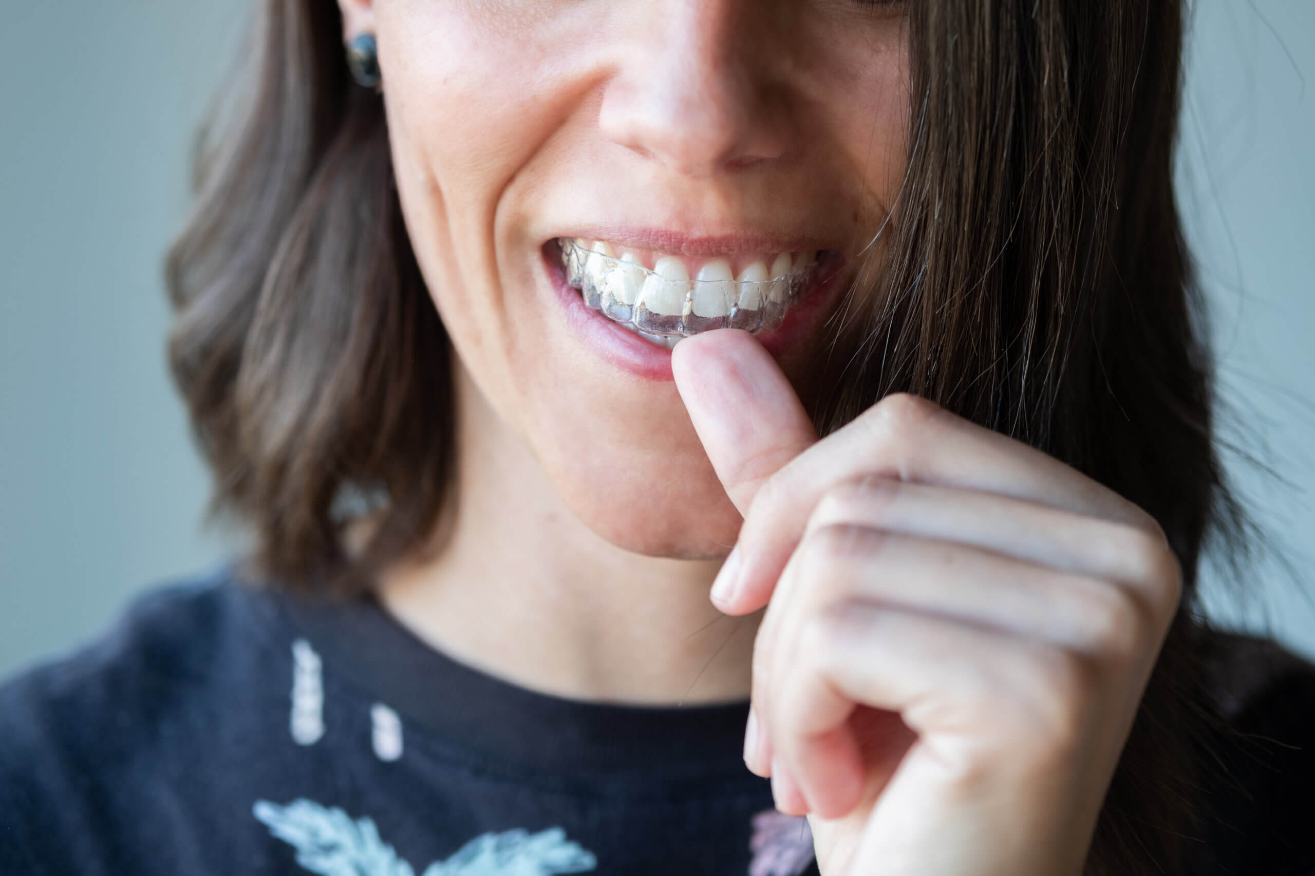 Why More Adults Are Choosing Invisalign in West Melbourne for a Straighter Smile