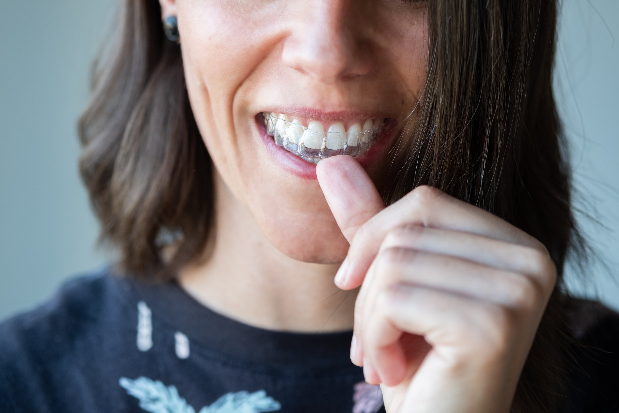 Why More Adults Are Choosing Invisalign in West Melbourne for a Straighter Smile