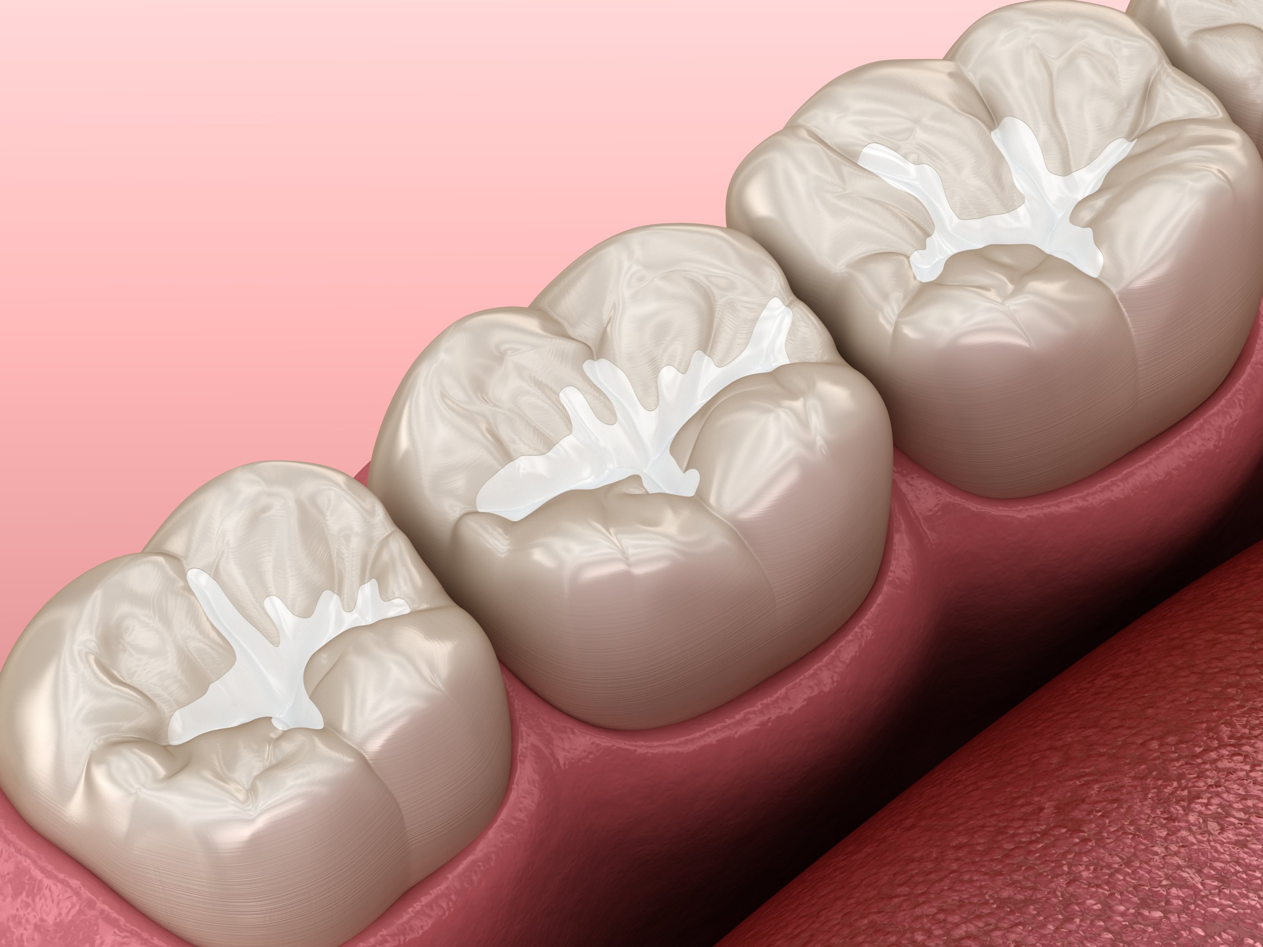 Melbourne, FL dentist dental sealants in West Melbourne